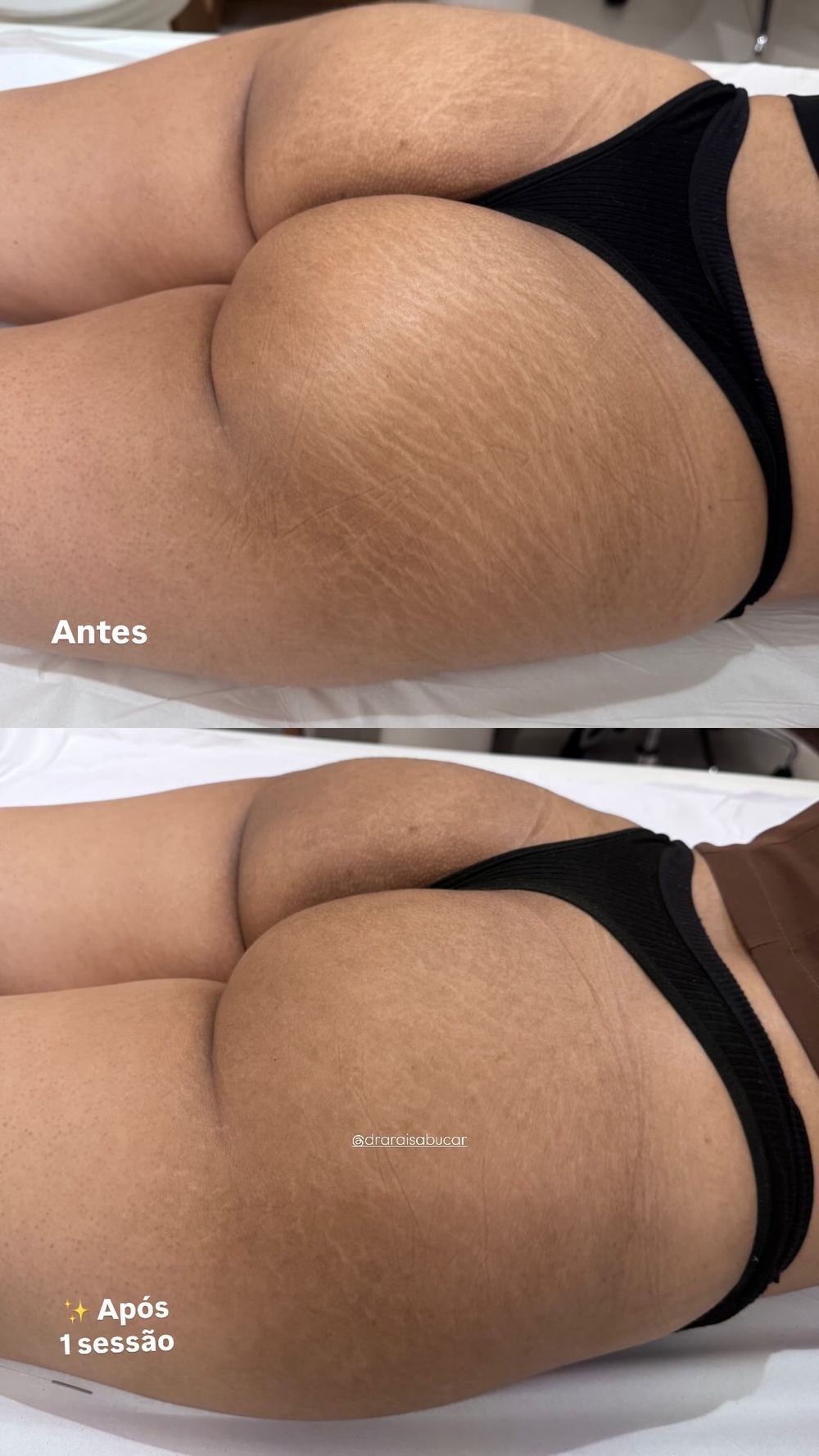 Resultado real de tratamento de estrias